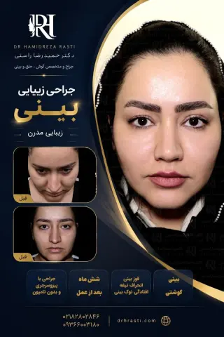 نمونه کار واقعی جراحی بینی دکتر حمیدرضا راستی - قبل و بعد