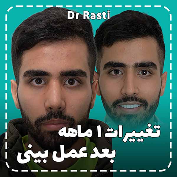 Cartilage rhinoplasty case example