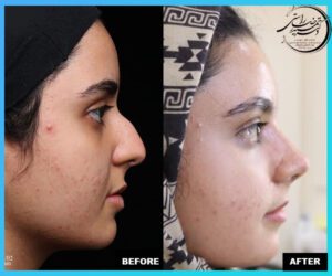 Rhinoplasty before and after