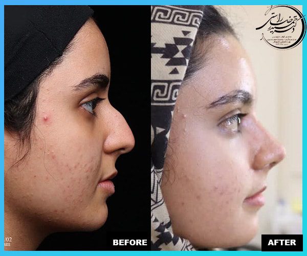 Rhinoplasty