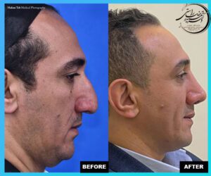 Rhinoplasty before and after