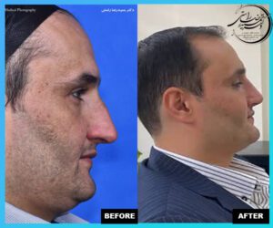 Rhinoplasty before and after