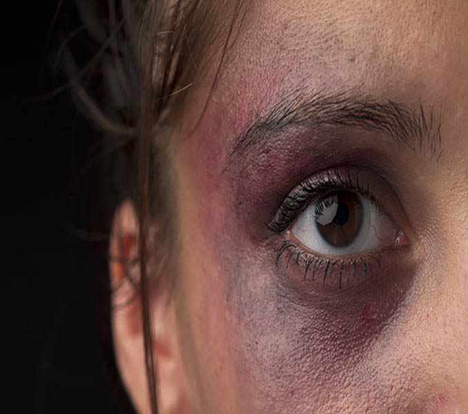 Why Does the Eye Bruise After Rhinoplasty? 3 Solutions