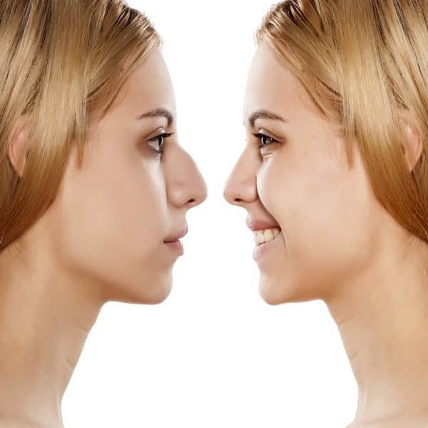 لماذا لا يجب أن تضحك بعد عملية تجميل الأنف؟