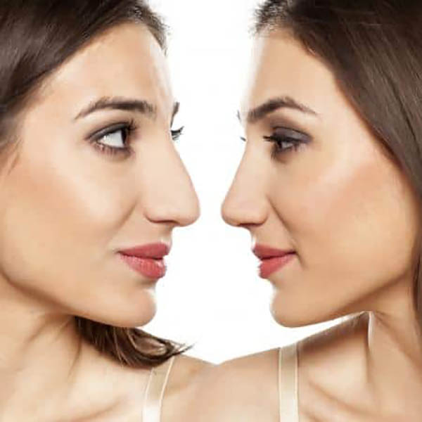 Why Do the Eyes Bruise and Swell After Rhinoplasty?