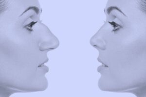 Rhinoplasty complications in older age