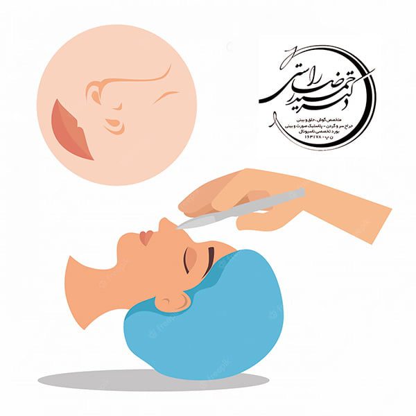 تصغير الأنف بدون جراحة