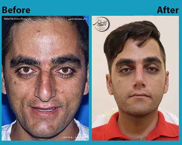 Nose surgery 21