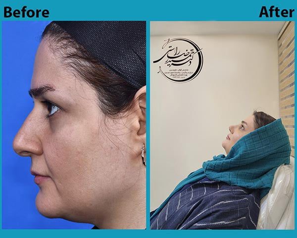 Nose surgery 20