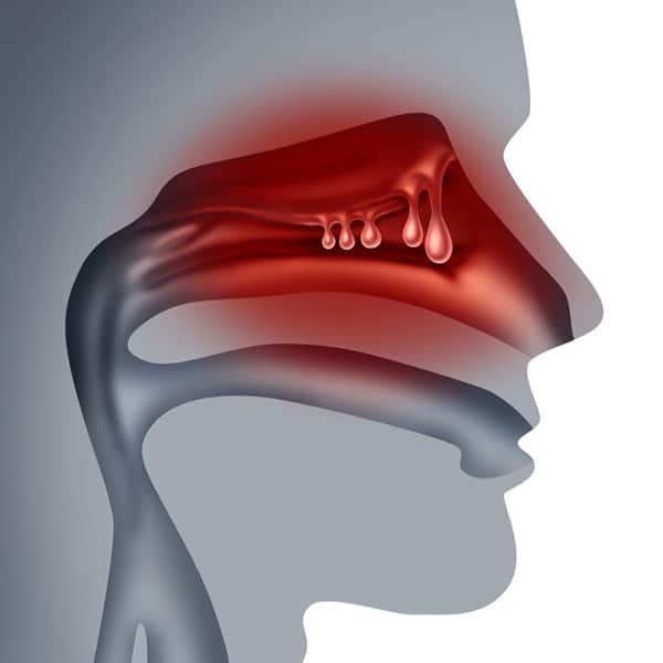 The Most Common Diseases of the Nose