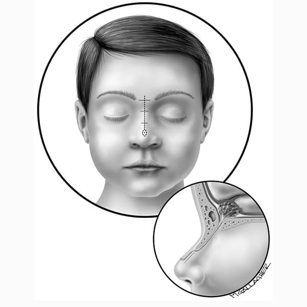 Nasal Cyst Symptoms, Diagnosis, and Treatment Options