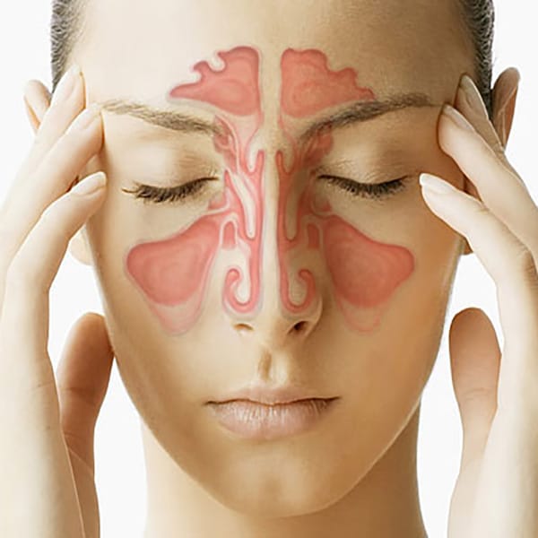 What Is Sinusitis?