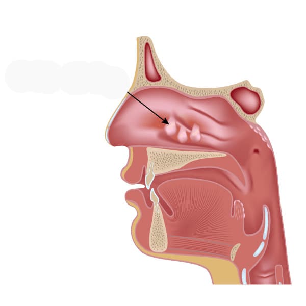 What Is a Nasal Polyp?
