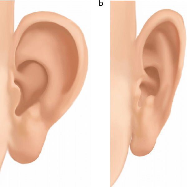 Best Otoplasty Surgeon in Tehran