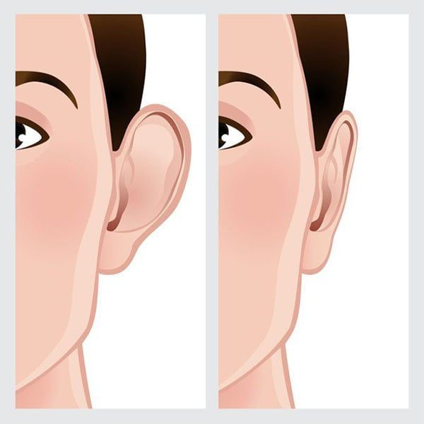 كم تكلف عملية تجميل الأذن؟