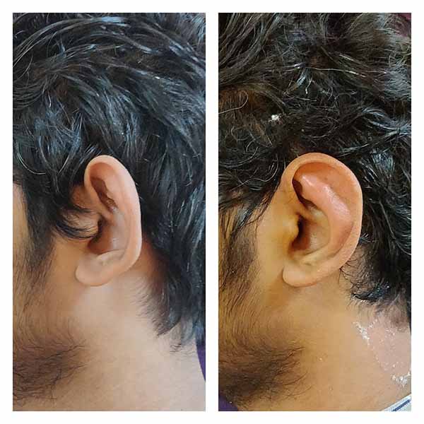 عمل اتوپلاستی