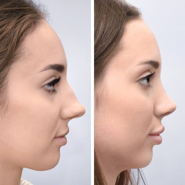 جراحة تجميل الأنف