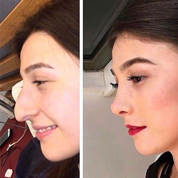 عمليات تجميل الأنف في إيران