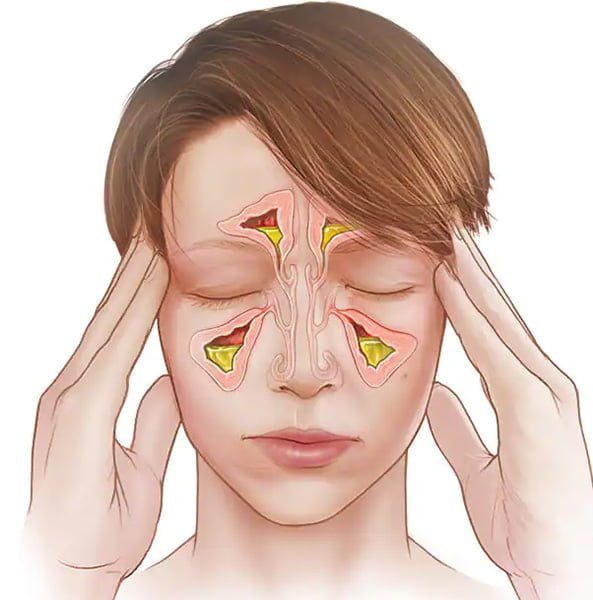 سینوزیت حاد چیست؟