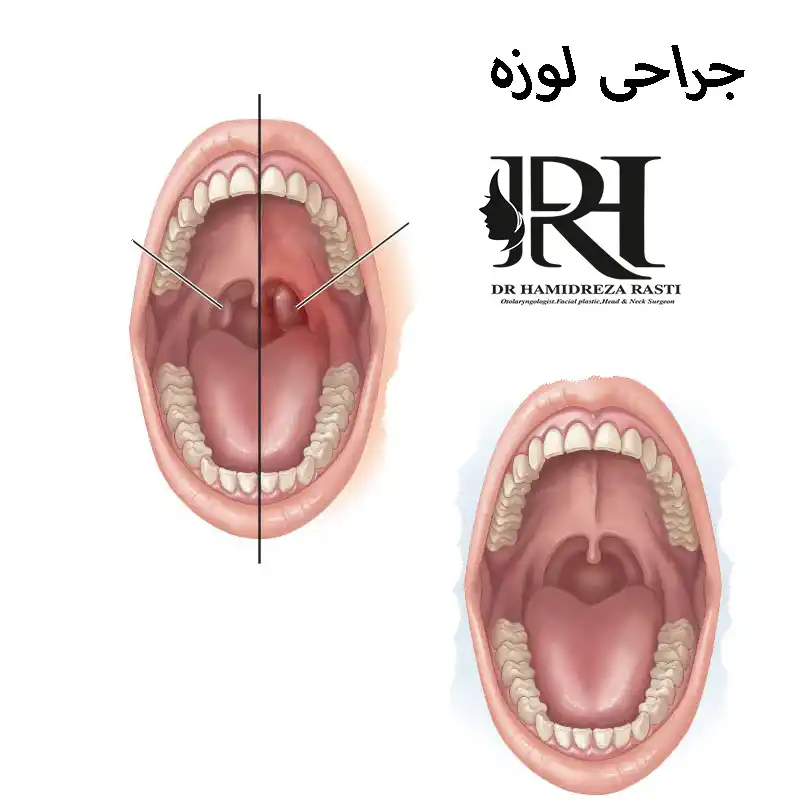 جراحی لوزه + هزینه ها