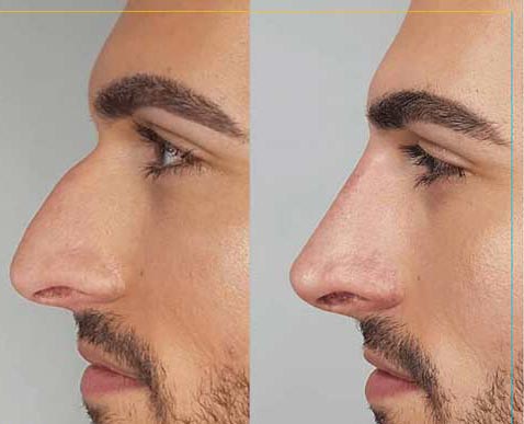 نحوه استفاده از لیزر در جراحی بینی برای دقت بالا و خونریزی کم