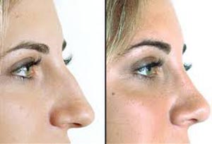 انواع عمل زیبایی بینی