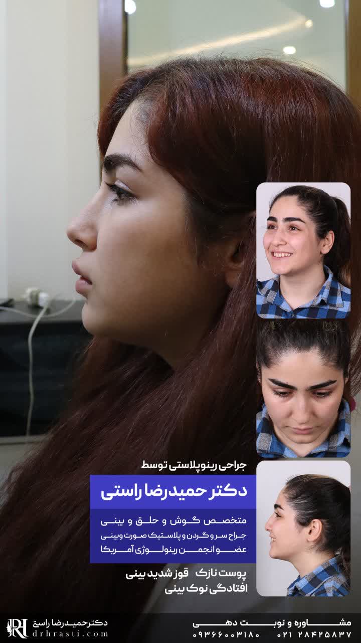 عکس جراحی بینی