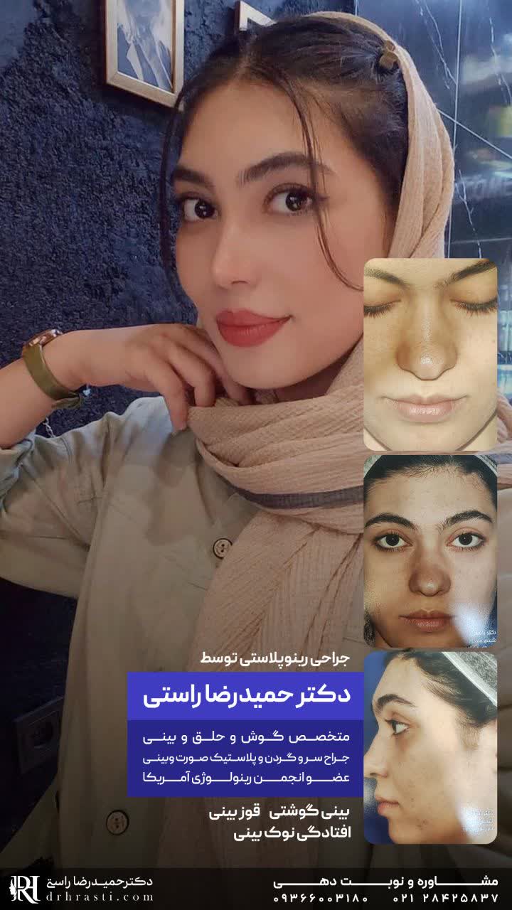 Rhinoplasty photo