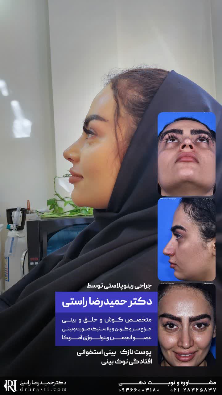 عکس بینی غضروفی