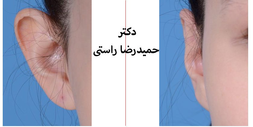 قیمت عمل زیبایی گوش در تهران