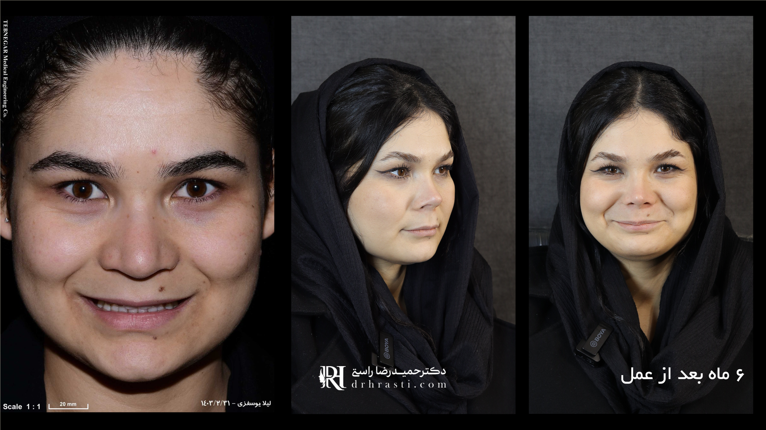 The Effect of Rhinoplasty on Facial Beauty and Harmony